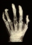 X-ray Hand Radiology Medicine