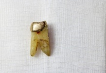 Pulled Molar With Caries