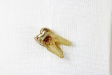 Pulled Molar With Caries