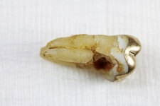 Side View Of A Pulled Molar