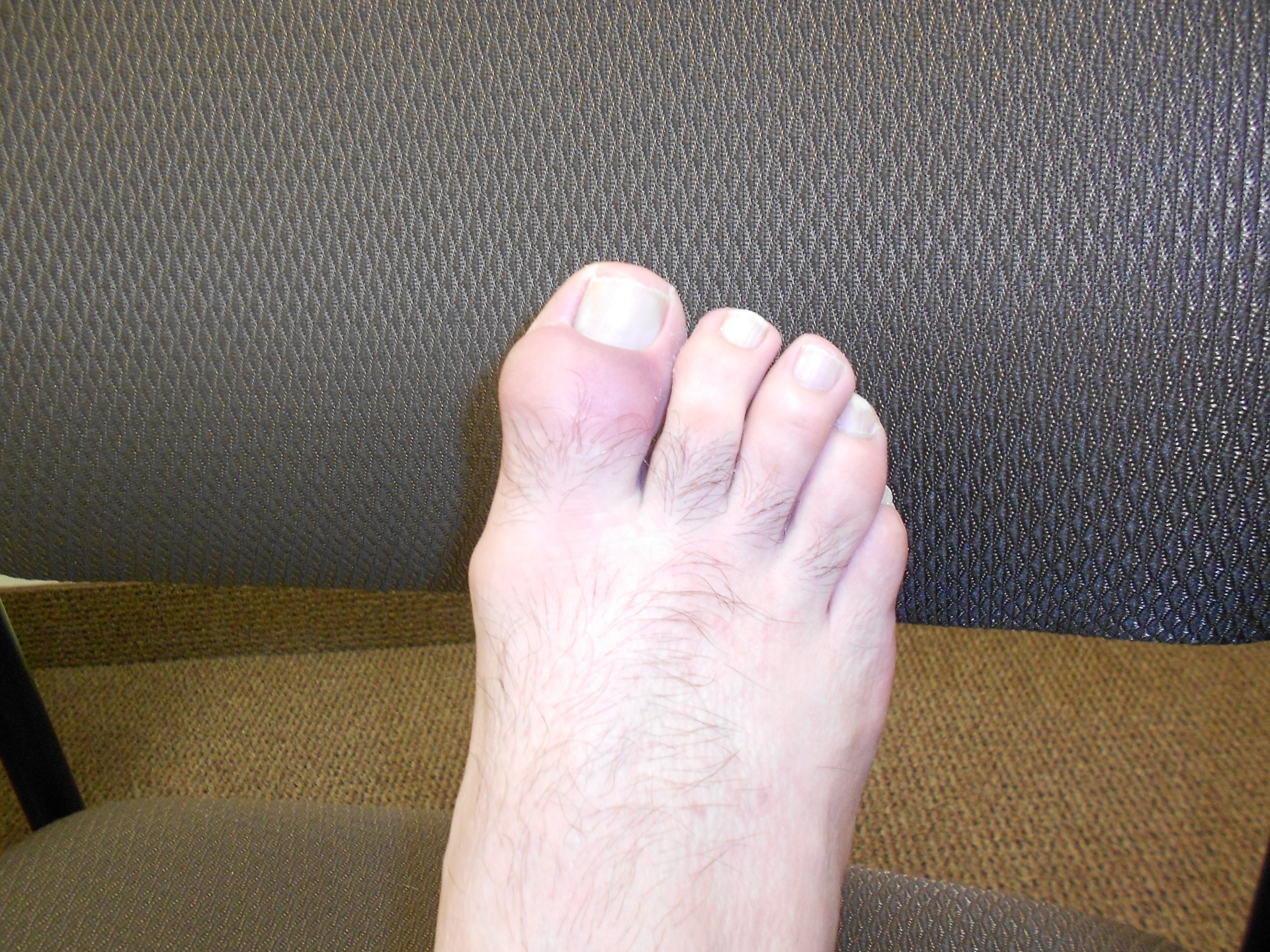 arthritis foot big toe gout