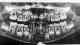 X-ray Of Growing Teeth