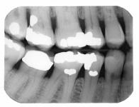 Dental X-ray Of Fillings, Teeth