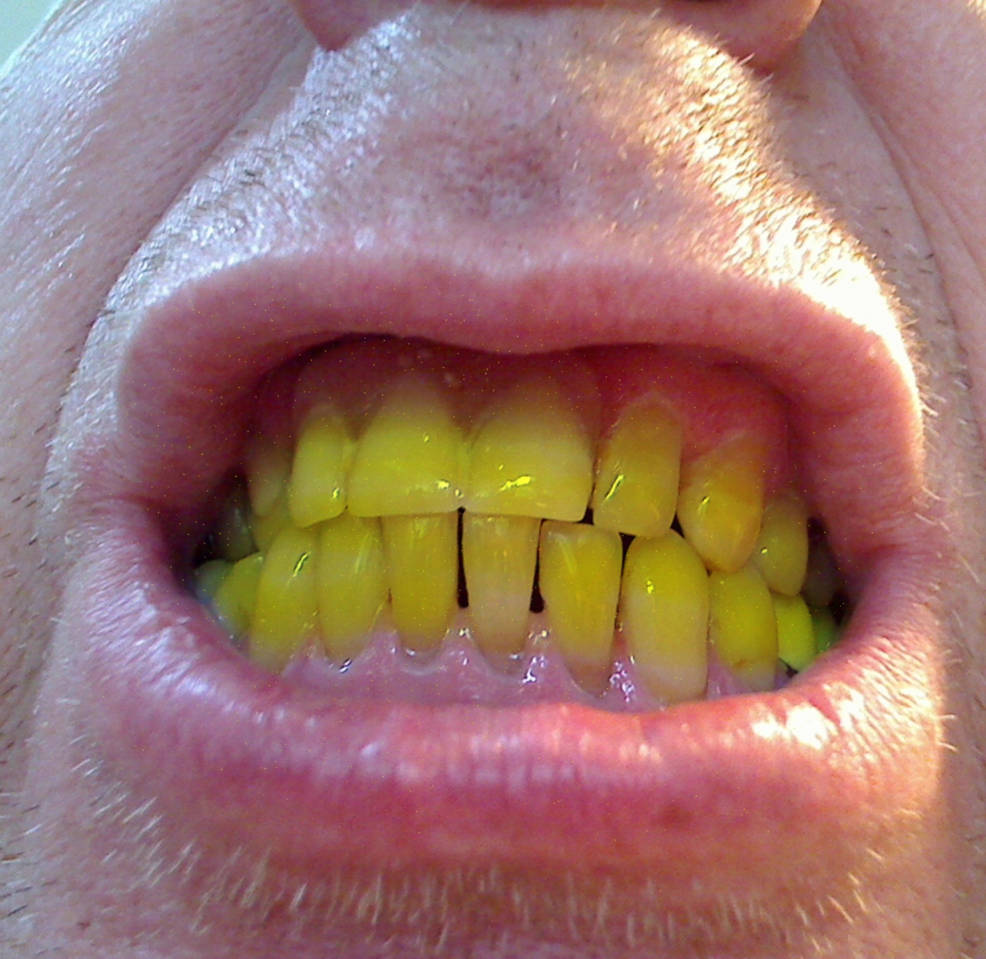 Health problem my yellow teeth
